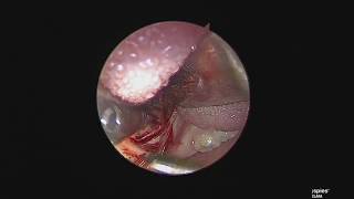 Cirurgia das Amigdalas e Adenoide