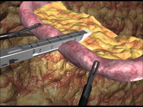 Cirurgia bariatrica em animação 3D