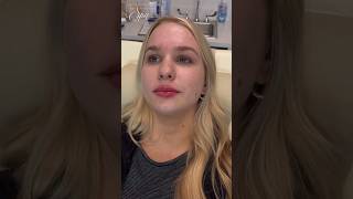 Dramatic Lip Augmentation: Before &amp; After