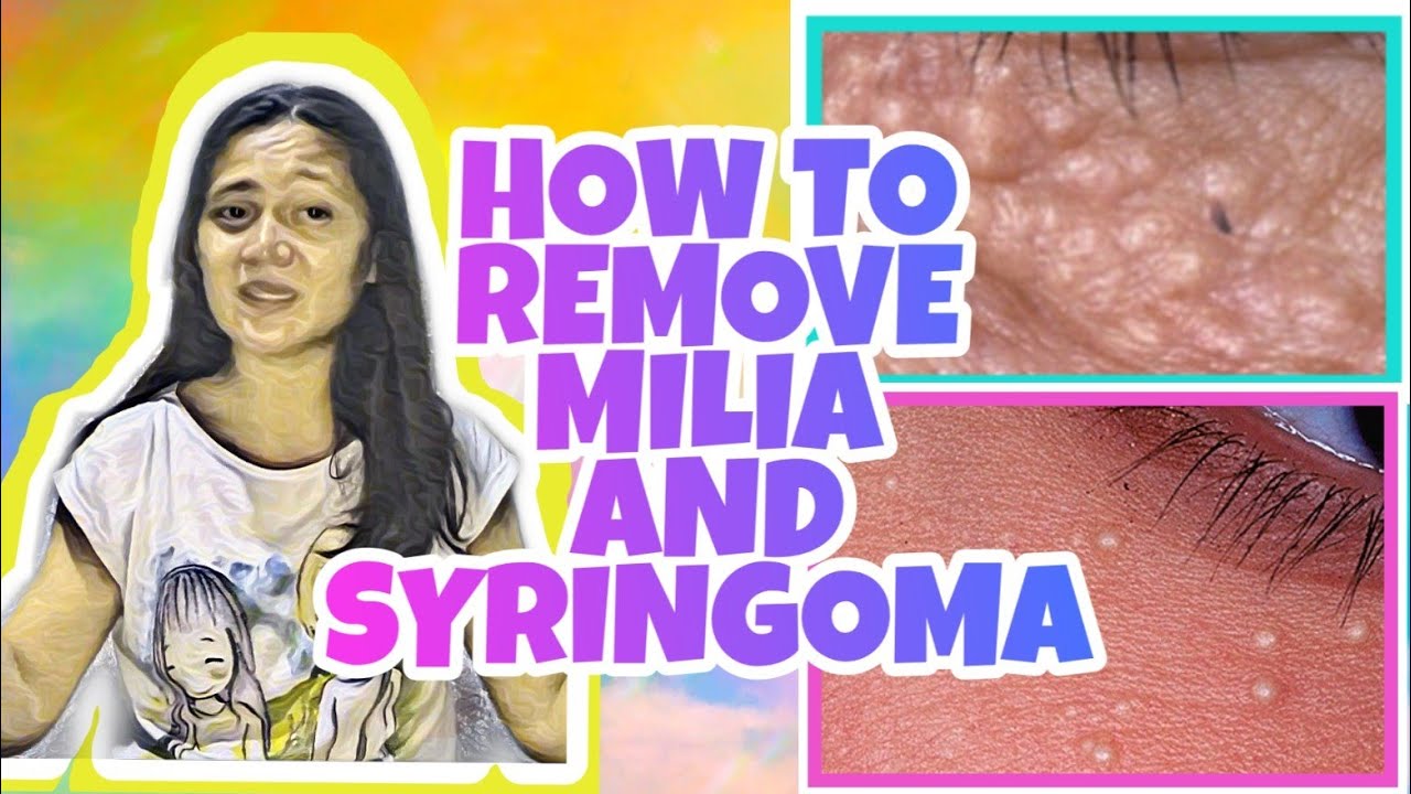 HOW TO REMOVE MILIA & SYRINGOMA