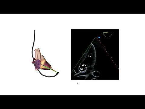 How to perform a transeosphageal echo (TOE)