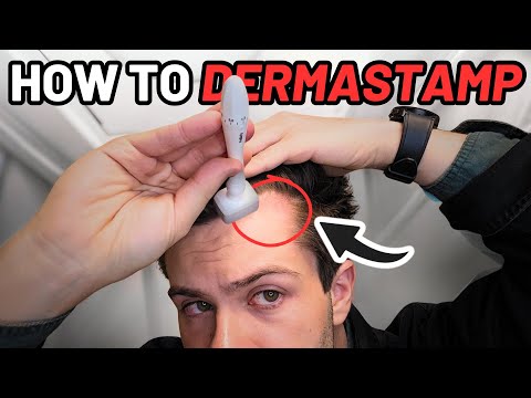 How to Derma Stamp for Quickest Hair Results (Step-by-Step Guide)