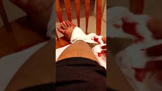 varicose vein bloodbath