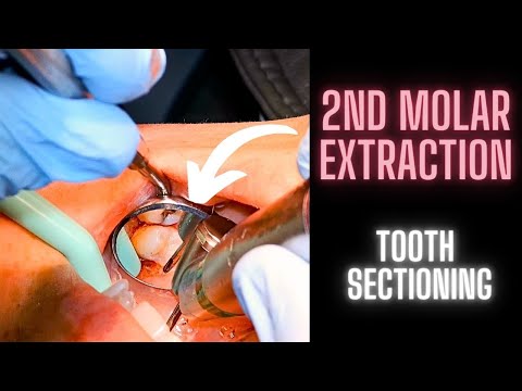 Chirurgische Extraktion eines maxillaren zweiten Molaren | Zahnschnittführung