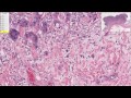 Cancerous Colon Tissue Video Tutorial