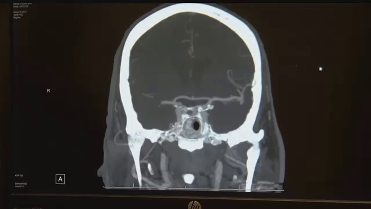 Your Healthy Family: Southern CO man survives stroke in textbook style