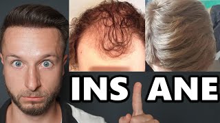 Best Finasteride + Rogaine Hair Loss Recoveries! #reddit  NW3 - NW6
