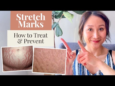 Avon Stretch Mark Cream Is Safe