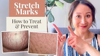 How to Treat and Prevent Stretch Marks (And the Products I Use) Dr. Jenny Liu