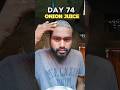 Day 74 Use Onion Juice For Hair Regrowth Hairregrowthtreatment Hairfall