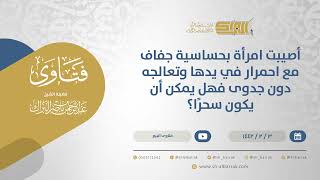 صورة أصيبت امرأة بحساسية جفاف مع احمرار في يدها وتعالجه دون جدوى فهل يمكن أن يكون سحرًا؟  (13908)