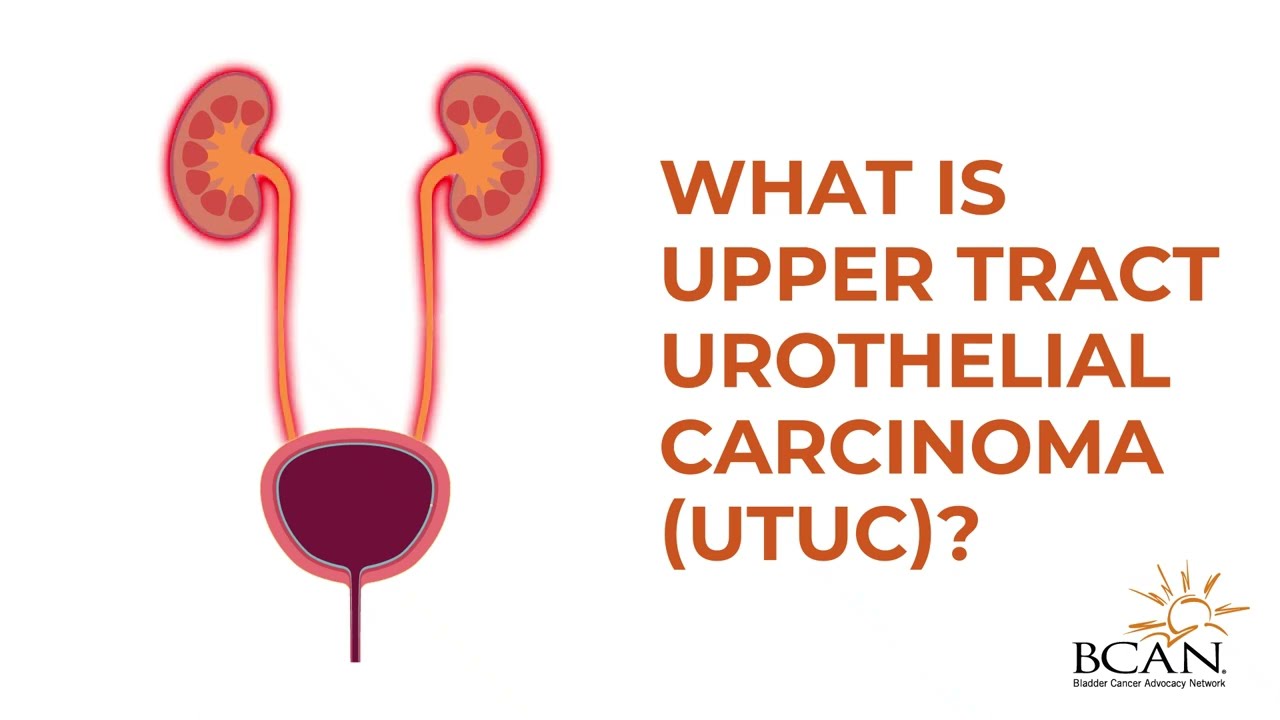 Utuc Ribbon Urothelial Carcinoma of the Upper Tract in with Dr. Dr. Johnson