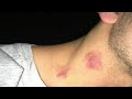 How To Give A Love Bite On Neck Step By Step