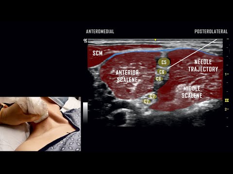 Interscalene Block // Ultrasound Anatomy Review