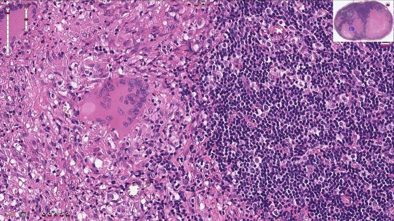 Tuberculosis of the Lymph Node - Histopathology