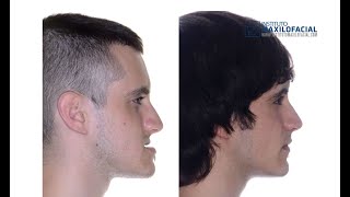 Cirugía ortognática bimaxilar. Caso #16: David - Clase 3