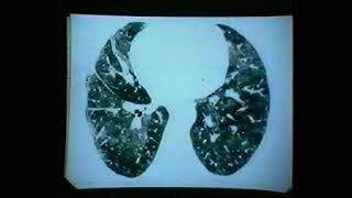 LUNG