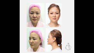 CINDERELLA BEAUTY SHOW #6 ULTHERAPY