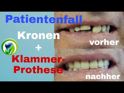 Patientenfall vorher - nachher / Klammer Zahnersatz mit Kronen | Modellguss |Regelversorgung