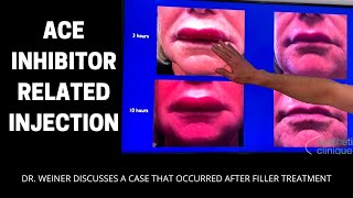 Extreme Lip Swelling After Injections is Angioedema Related to A Blood Pressure Medication