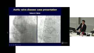 TAVI for Prosthetic Valve Dysfunction – Dr David Muller