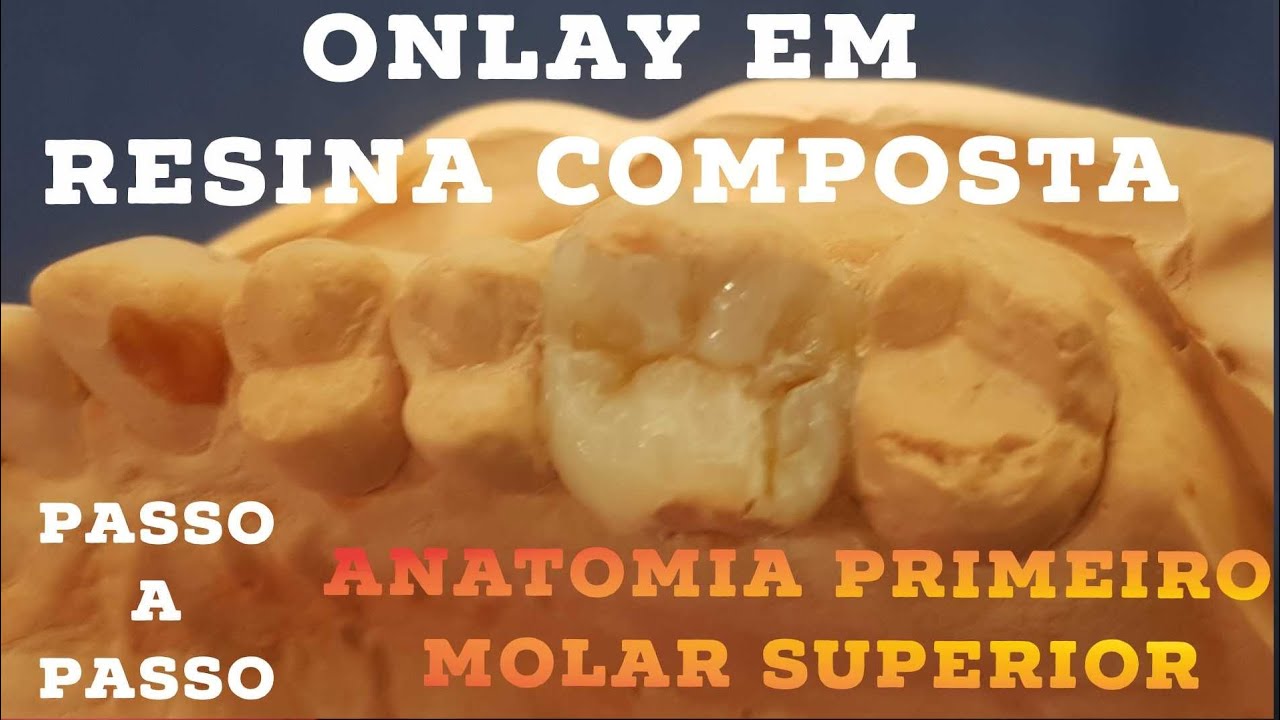 🛑ONLAY EM RESINA COMPOSTA: BONUS ANATOMIA FÁCIL DO PRIMEIRO MOLAR SUPERIOR🤫✍