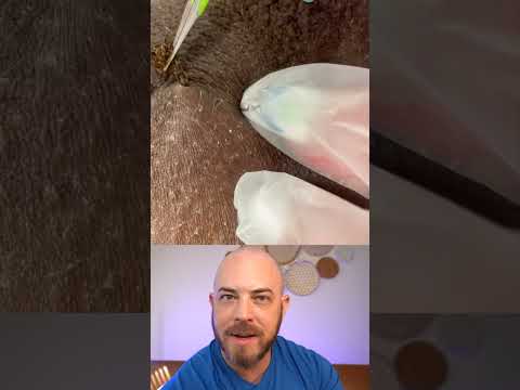 Derm reacts to INSANE ingrown hair extraction! 