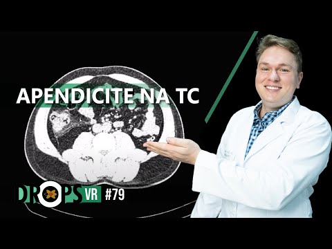 APENDICITE NA TC  PASSO A PASSO