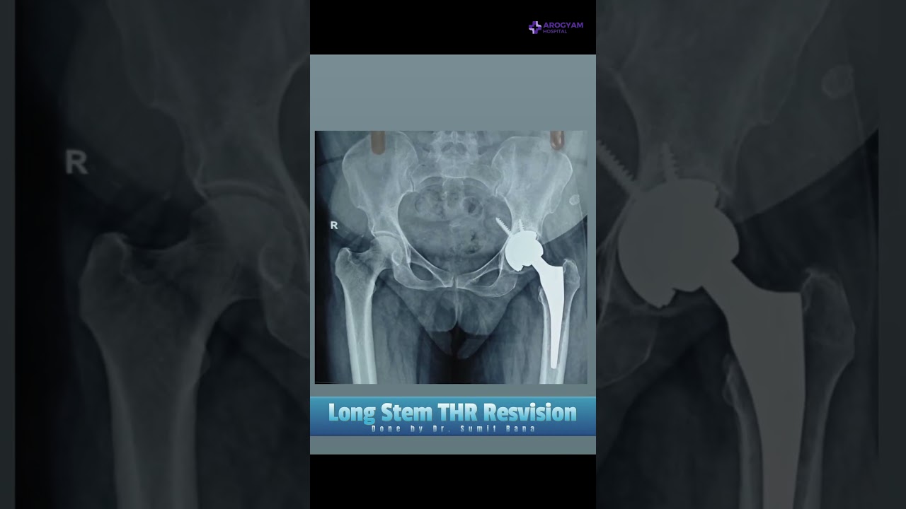 First time ( Long stem THR Revision ) done by Dr. Sumit Rana Orthopaedic Surgeon in Arogyam History