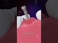 Bone Grafting For Dental Implants Shorts Facts Creativelearning3d