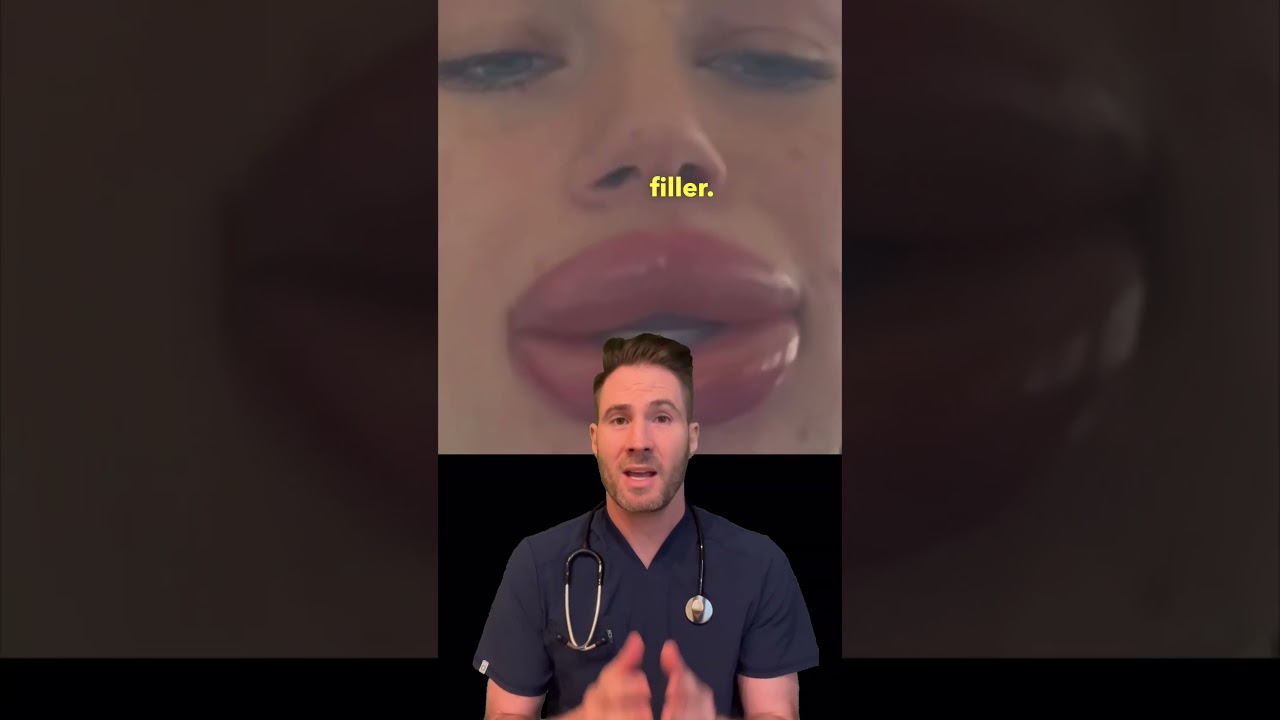 Lip filler gone wrong… 👄 😳