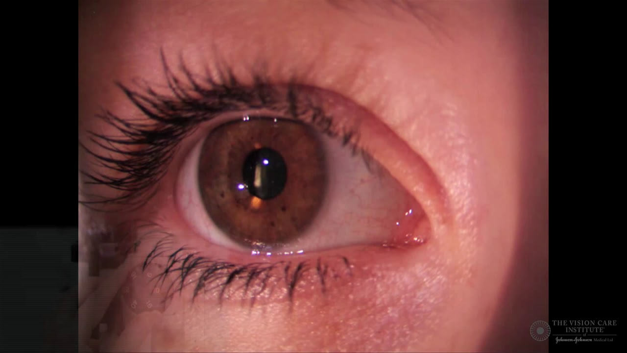 Slit Lamp Techniques   Specular Reflection   Anterior Lens