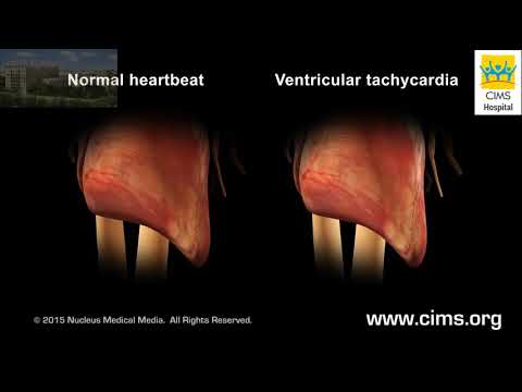 Cardiac Arrhythmia - CIMS Hospital
