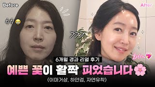 [리얼모델 VLOG] 예쁜 꽃이 활짝 피었습니다｜이마거상, 하안검, 자연유착 6개월 경과 리얼 후기 #일퍼센트성형외과
