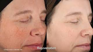 UltraClear® LÁSER DE FIBRA ABLATIVO MICROTHERMAL