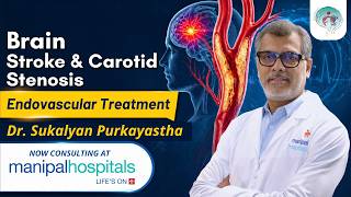 Brain Stroke & Carotid Stenosis Treatment | Dr. Sukalyan Purkayastha | Brain Mechanic in Kolkata
