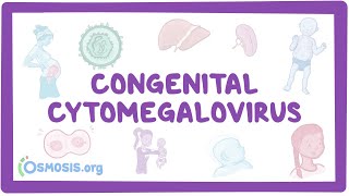 Congenital CMV - causes symptoms diagnosis treatme