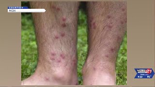 Allergic reaction caused by parasites draws renewed attention to a rash called 