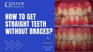 How to Get Straight Teeth Without Braces - Gluck Orthodontics
