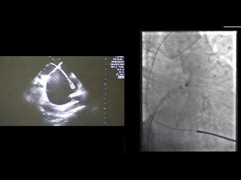 Left Atrial Appendage Closure by Watchman FLX and ICE