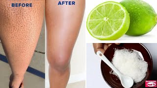How to Get Rid of Strawberry Leg in 1 day with Lemon & Sugar / Remove Keratosis Pilaris & Dark Spot