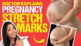 TREAT Stretchmarks during Pregnancy Doctor V explains