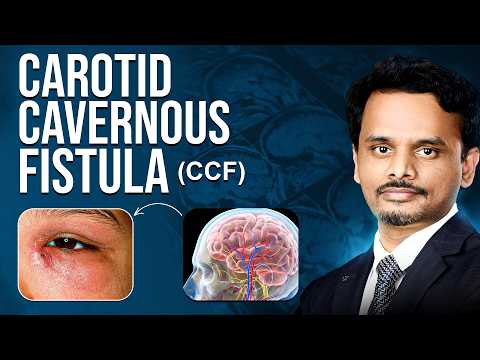 Carotid-Cavernous Fistula (CCF) - Complete Patient Guide | Dr. Suresh Giragani