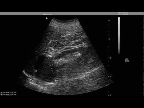 A causa di ciò che appare adenoma prostatico Se è possibile analizzare lurina per scoprire prostatite