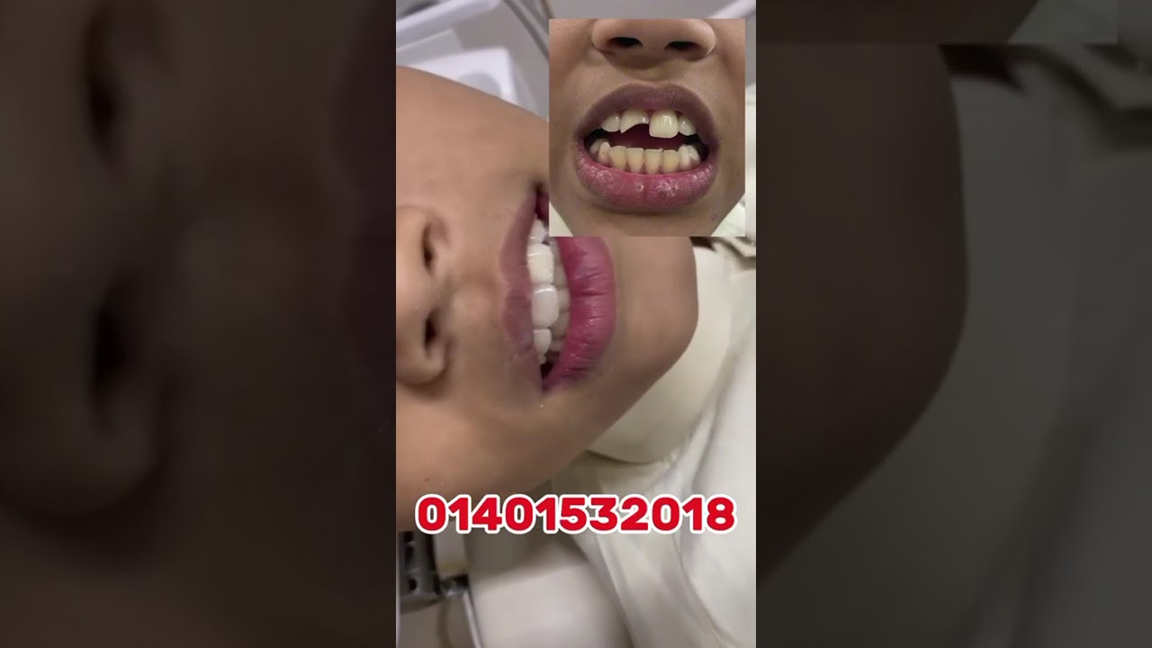 ভাঙ্গা দাঁতের সমাধান করা হয়েছে মাদ্রাসা শিক্ষার্থী ভাইয়ের। - ভিডিও পর্যালোচনা