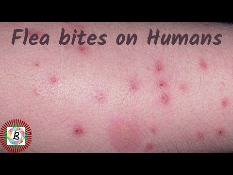How To Identify Flea Bite Allergies On Humans