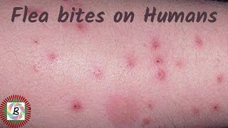 How To Identify Flea Bite Allergies On Humans, flea bites in humans