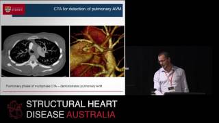 What MRI and CT now reveal about the left atrium – Prof Stuart Grieve
