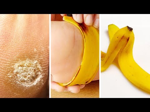 download lagu mp3 mp4 Banana Wart, download lagu Banana Wart gratis, unduh video klip Banana Wart
