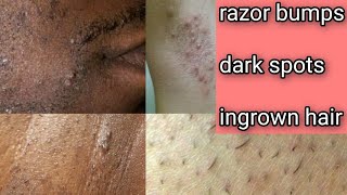 HOW TO GET RID OF RAZOR BUMPS, DARK SPOTS AND INGROWN HAIR.